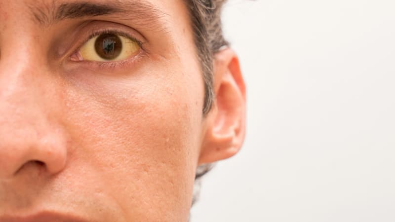 Žloutenka v Česku zabíjí. Zemřelo už přes 30 lidí, nakažených je dvacetkrát více než loni